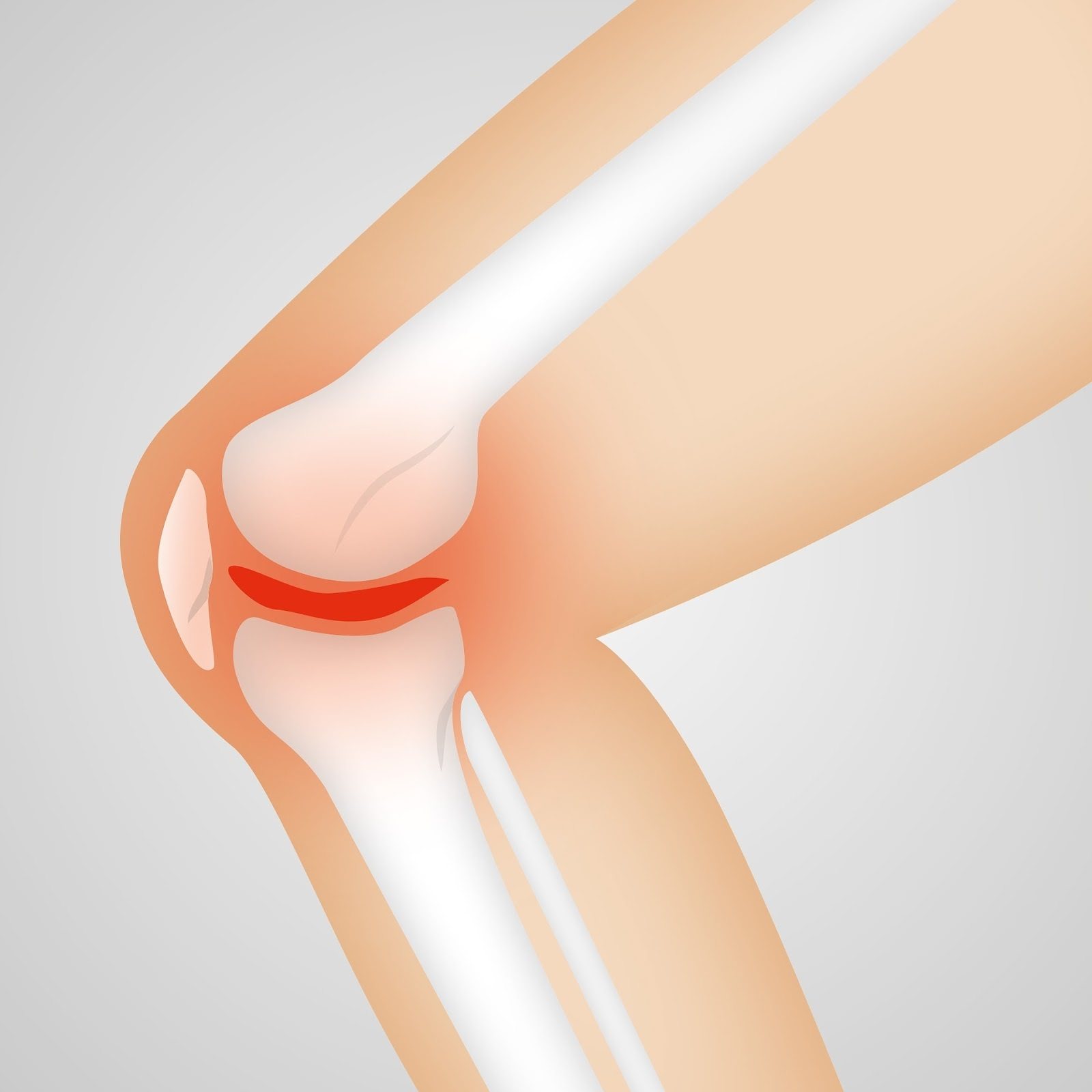 Ernährung bei Arthrose