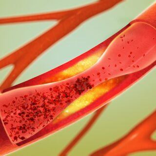 Arteriosklerose