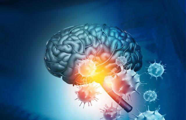 Meningitis - Ursachen, Symptome und Behandlung