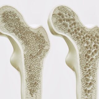 Osteoporose Osteoporose – Ursachen, Symptome und Behandlung