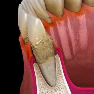 Parodontitis - Ursachen, Symptome und Behandlung