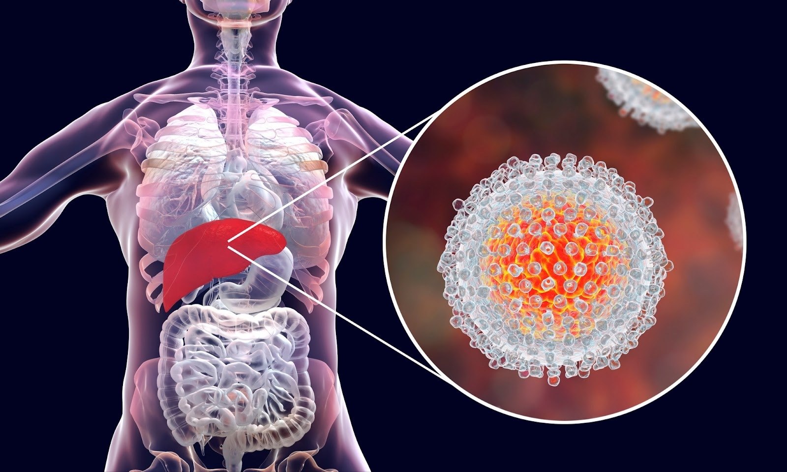 Hepatitis C – Ursachen, Symptome und Behandlung