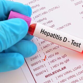 Hepatitis D – Ursachen, Symptome und Behandlung