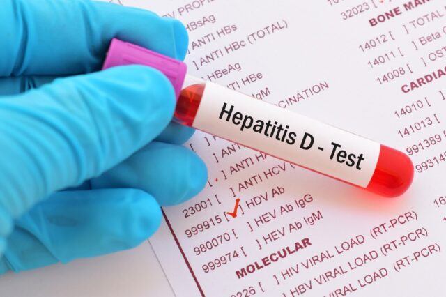 Hepatitis D – Ursachen, Symptome und Behandlung